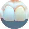 dental-crowns