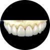 dental-veneers